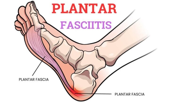 Best Insoles for Plantar Fasciitis